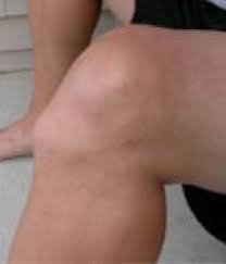 Professional Health Systems: Osgood-Schlatter Disease