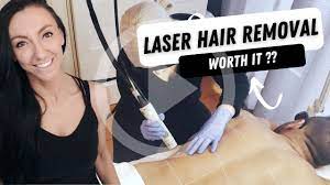 laser hair removal with sparkle you