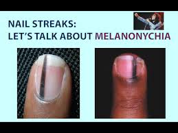streaks in your nails let s talk about