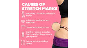 can body makeup cover stretch marks