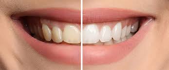 For some, smoking and chewing tobacco products over the years leads to staining. What Causes Teeth Stains How Do You Get Rid Of Them