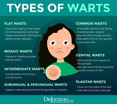 skin warts major causes and natural