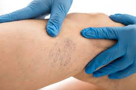 spider veins removal treatment and