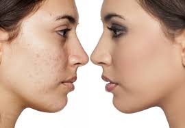 acne scar and pits reduction la