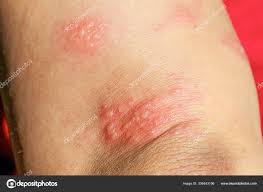 skin rash as allergic symptoms due to
