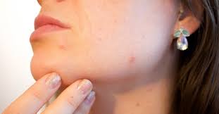 home remes for skin diseases and