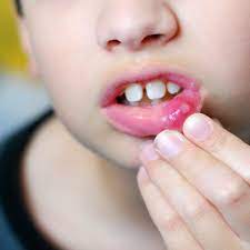 what to do about your kid s cold sore