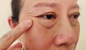 under eye bags treatment dr elizabeth