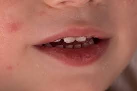 how to handle teething rash