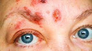 what causes a rash around the eye how