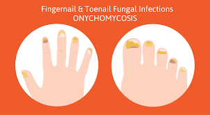 fingernail fungus laser treatment fi