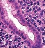 Image result for icd 10 code for helicobacter pylori gastritis