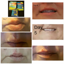 lip clear for cold sore treatment