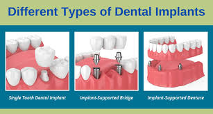 diffe types of dental implants