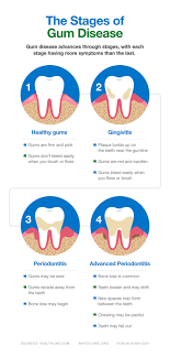 what causes periodonis and how to