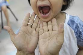 The illness is caused by a number of enteroviruses with coxsackievirus a16 and enterovirus 71 as the main causative agents. Hand Foot And Mouth Disease Outbreak In Malaysia 6 Things You Need To Know About The Disease Health News Top Stories The Straits Times