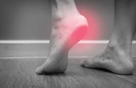 what is a plantar fascia rupture