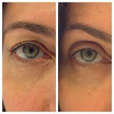 want an eye lift without surgery here