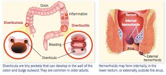 Find symptoms,causes and treatments of hemorrhoids.for your health. When Your Colonoscopy Reveals That You Have Diverticulosis Hemorrhoids Or Both Harvard Health