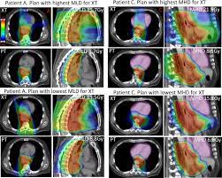 oesophageal cancer