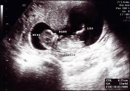 Crown Rump Length Chart Fetal Ultrasound Measurements