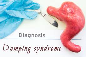 dumping syndrome