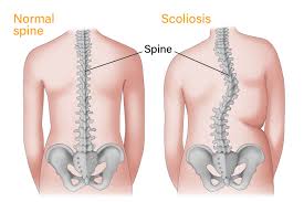 can scoliosis cause herniated discs