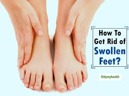 home remes to treat swollen ankles