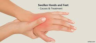 swollen hands and feet causes treatment
