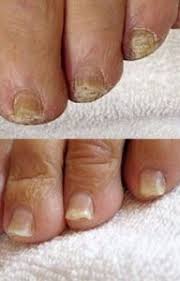 fungal nail infections oasis