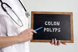 colon polyps diagnosis and icd 10