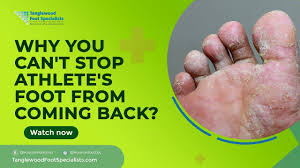 why you can t stop athletes foot from