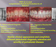 exam 2 the comprehensive periodontal