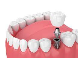 dental implants procedure costs