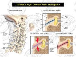 traumatic right cervical facet arthropathy