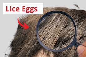 dead vs live nits color of lice eggs