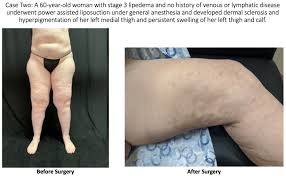 lymphatic injury after liposuction