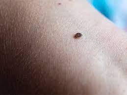 bed bug bites pictures treatment and