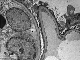 anti glomerular basement membrane