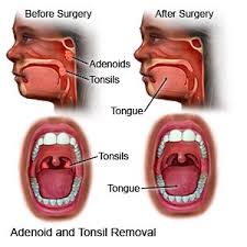 tonsillectomy what you need to know