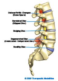 holistic spinal stenosis treatment