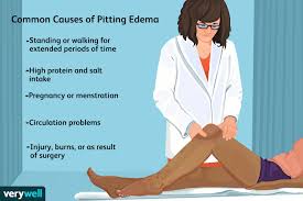 pitting edema what it is symptoms