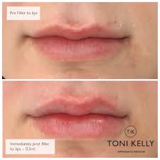 dermal fillers lip fillers cheek