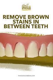 Apply this mixture onto your stained teeth and vigorously rub it onto your teeth and gums. How To Remove Brown Stains In Between Teeth Teeth Stain Remover Stained Teeth Discolored Teeth