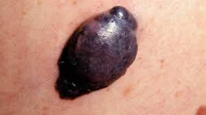 Alm is a type of melanoma that develops on the palms, soles, and the skin under the nails. Nodular Melanoma Symptoms Risk Factors Diagnosis And Treatment