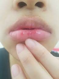 ps on my lips are a rash or hsv