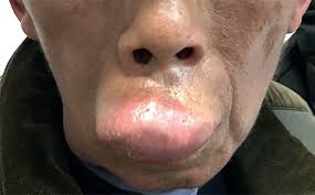 an unusual cause of lip and cheek swelling