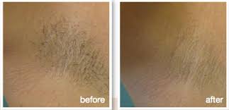 The pigment in the hair converts the laser light to heat, which reaches a hot enough temperature to destroy the hair and the follicle which produces it. Laser Hair Removal Pain Free Derma Health Institute