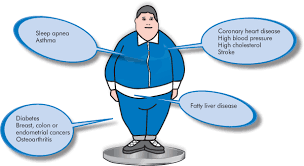 What Causes Obesity And Overweight ?