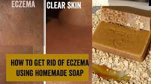 how to get rid of eczema with homemade